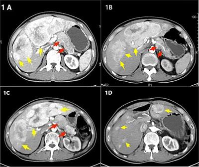 Case report: Surgical treatment and literature review of a recurrent case of glucagonoma